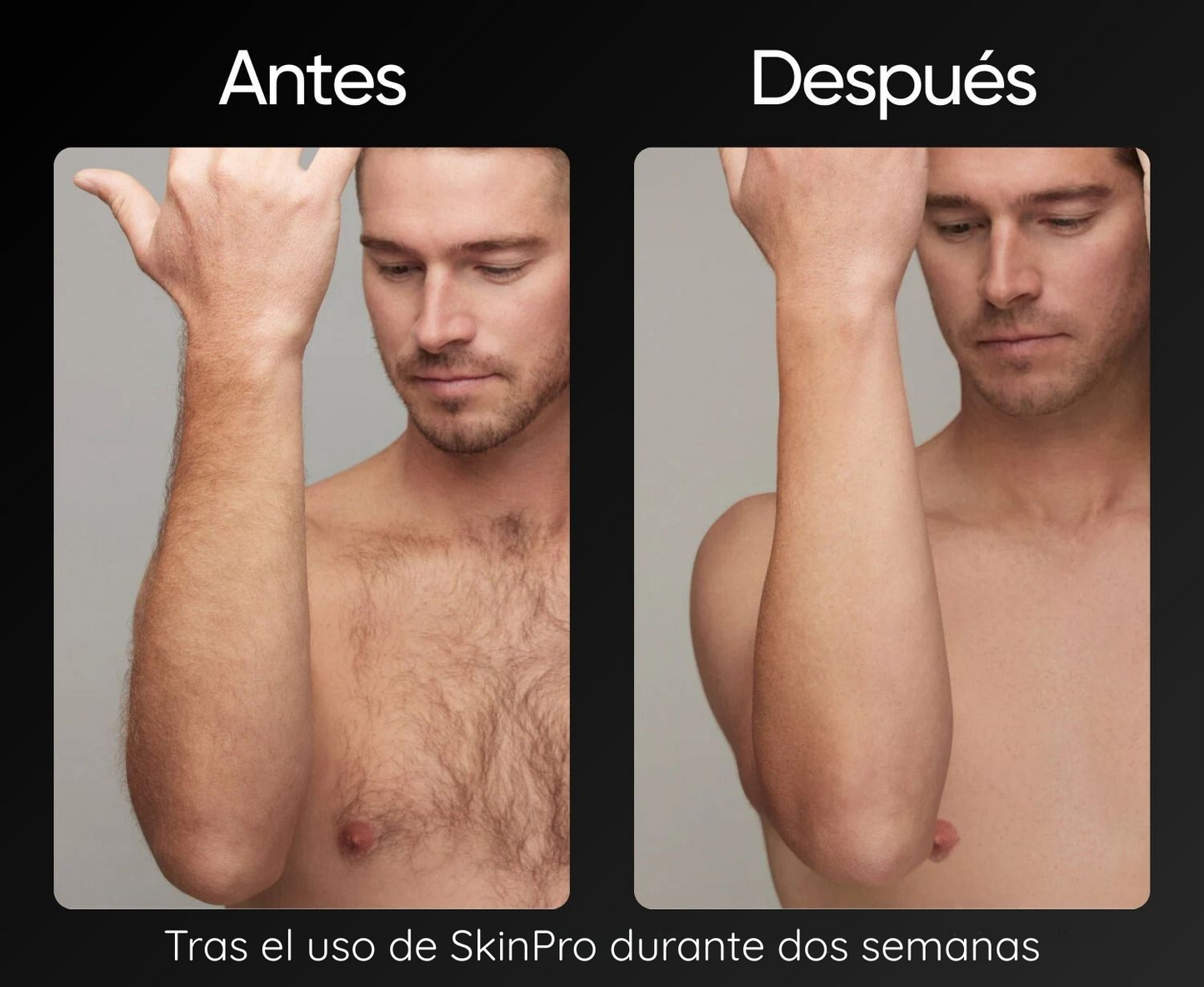 SkinPro | Depiladora Láser Permanente